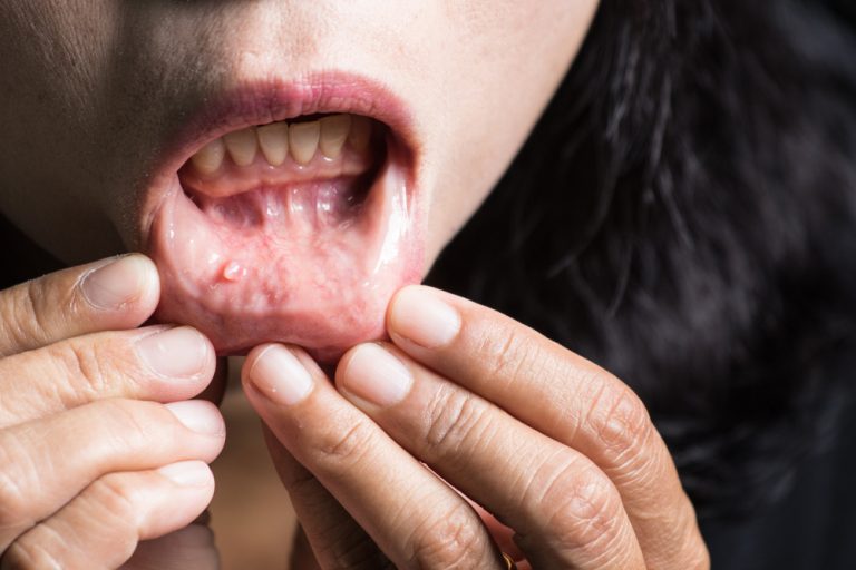 mouth-cancer-how-to-self-check-eden-rise-dental